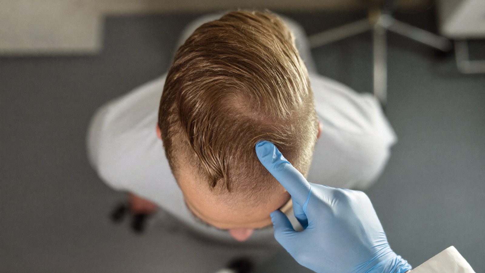 Top-down view of a man's crown under clinic lights while a gloved hand points to the swirl of hair at the vertex