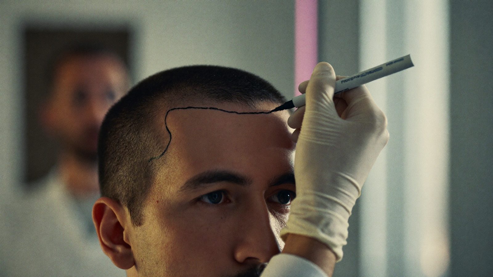 Doctor drawing a soft, irregular hairline on a smiling man's forehead with a surgical marker