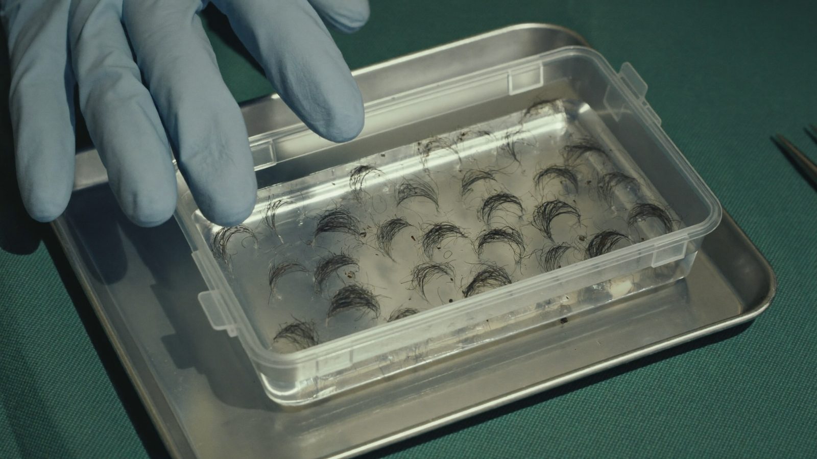 Gloved hand beside a clear storage container of hair follicle grafts on a sterile surgical tray