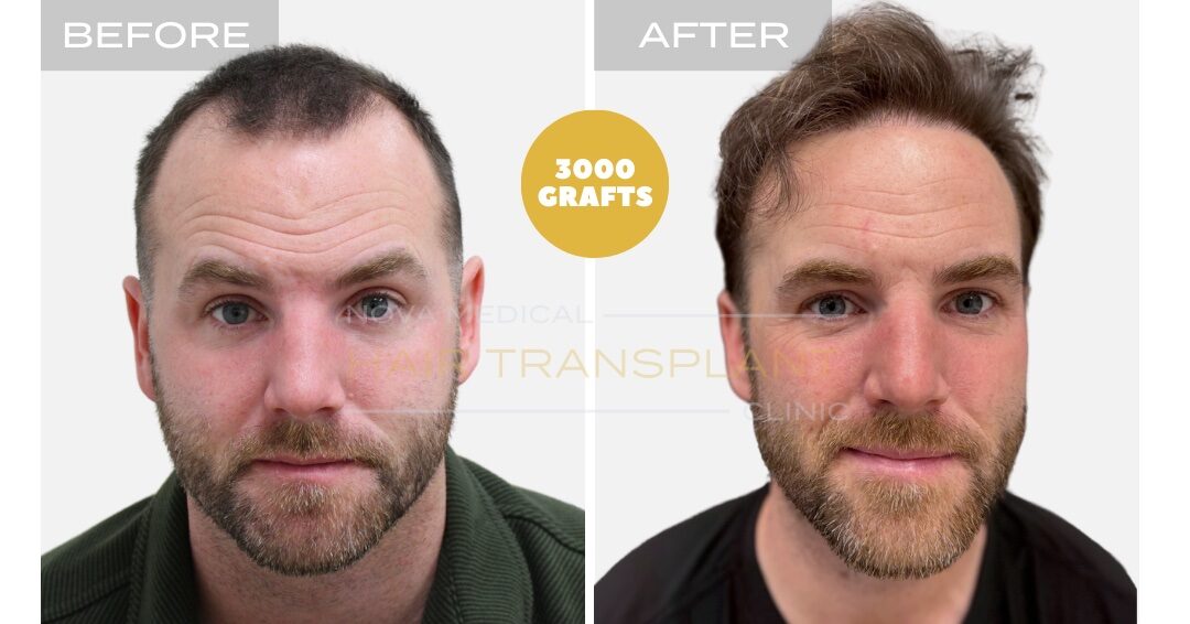 Hair Transplant Before & After Result 4 - HAIRLINE RESTORATION + DENSITY FILLING. MANUAL FUE 3000 GRAFTS., Nova Medical NYC