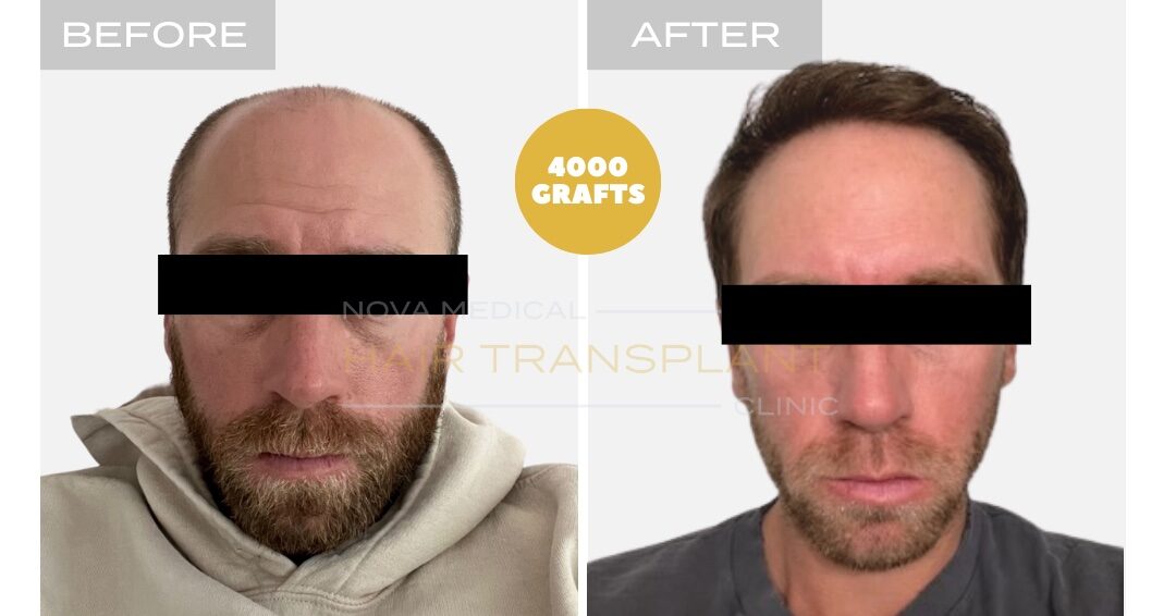 Hair Transplant Before & After Result 5 - HAIRLINE FORMATION + CROWN DENSITY RESTORATION. MANUAL FUE 4000 GRAFTS + DHI., Nova Medical NYC