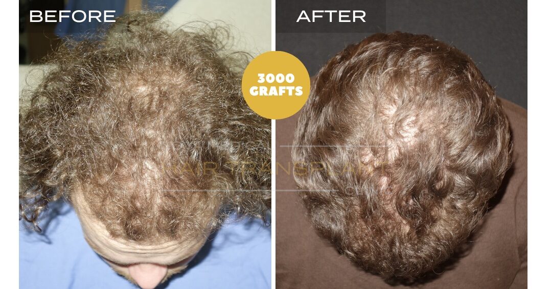 Hair Transplant Before & After Result 6 - FOR CURLY HAIR. DENSITY FILLING. SHAVELESS MANUAL FUE 3000 GRAFTS, Nova Medical NYC