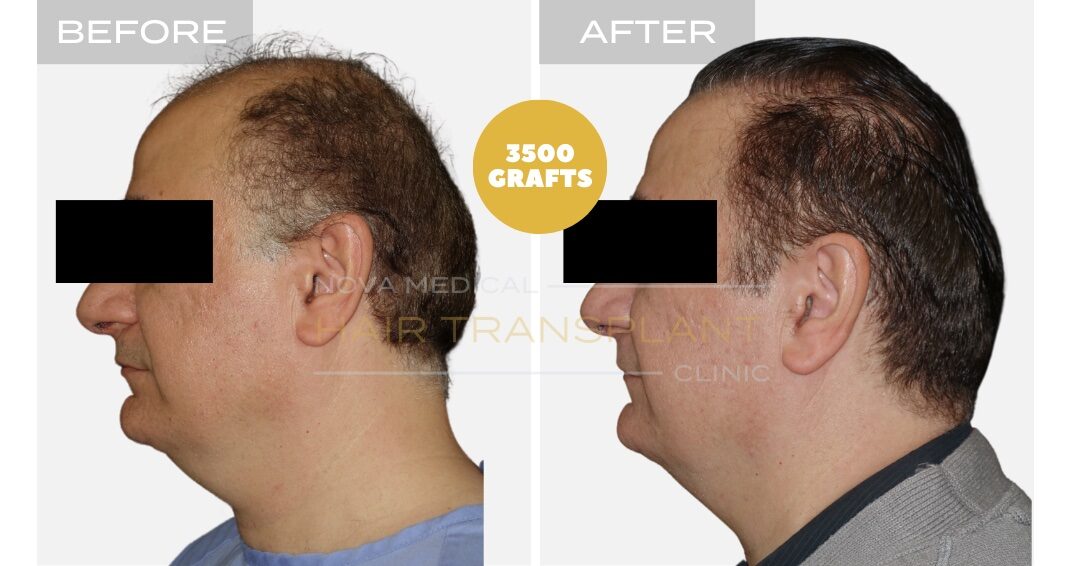 Hair Transplant Before & After Result 8 - HAIRLINE FORMATION + CROWN DENSITY RESTORATION. MANUAL FUE 3500 GRAFTS., Nova Medical NYC