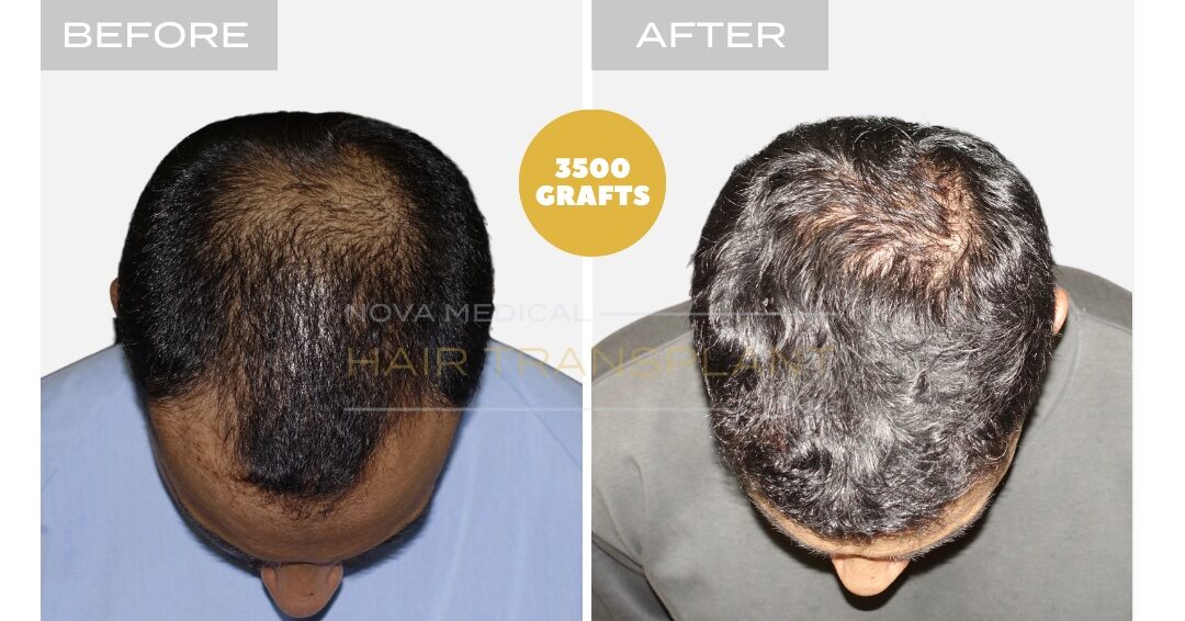 Hair Transplant Before & After Result 10 - THICK HAIR HAIRLINE RESTORATION. MANUAL FUE 3500 GRAFTS., Nova Medical NYC