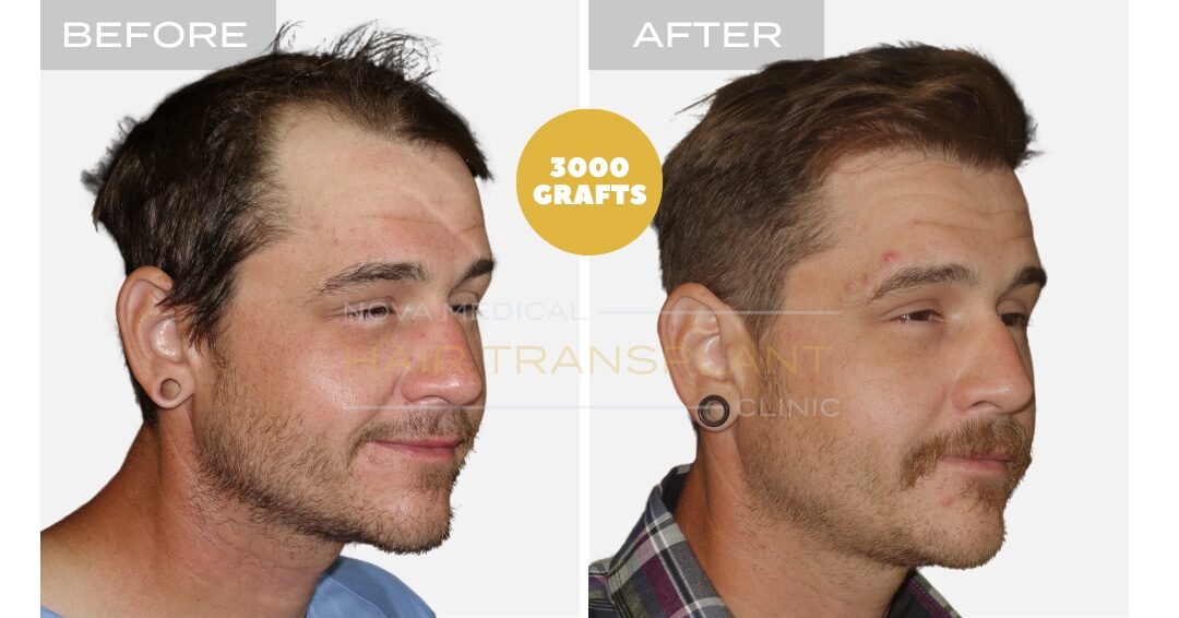 Hair Transplant Before & After Result 11 - HIGH DENSITY HAIRLINE RESTORATION. MANUAL FUE 3000 GRAFTS., Nova Medical NYC
