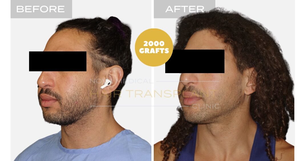 Hair Transplant Before & After Result 12 - NON-SHAVE CURLY HAIRLINE RESTORATION. MANUAL FUE 2000 GRAFTS., Nova Medical NYC