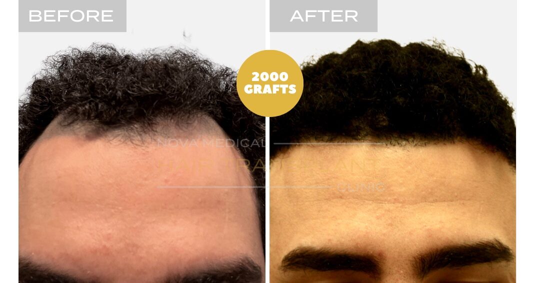 Hair Transplant Before & After Result 13 - HAIRLINE RESTORATION + DENSITY FILLING. MANUAL FUE 3000 GRAFTS., Nova Medical NYC
