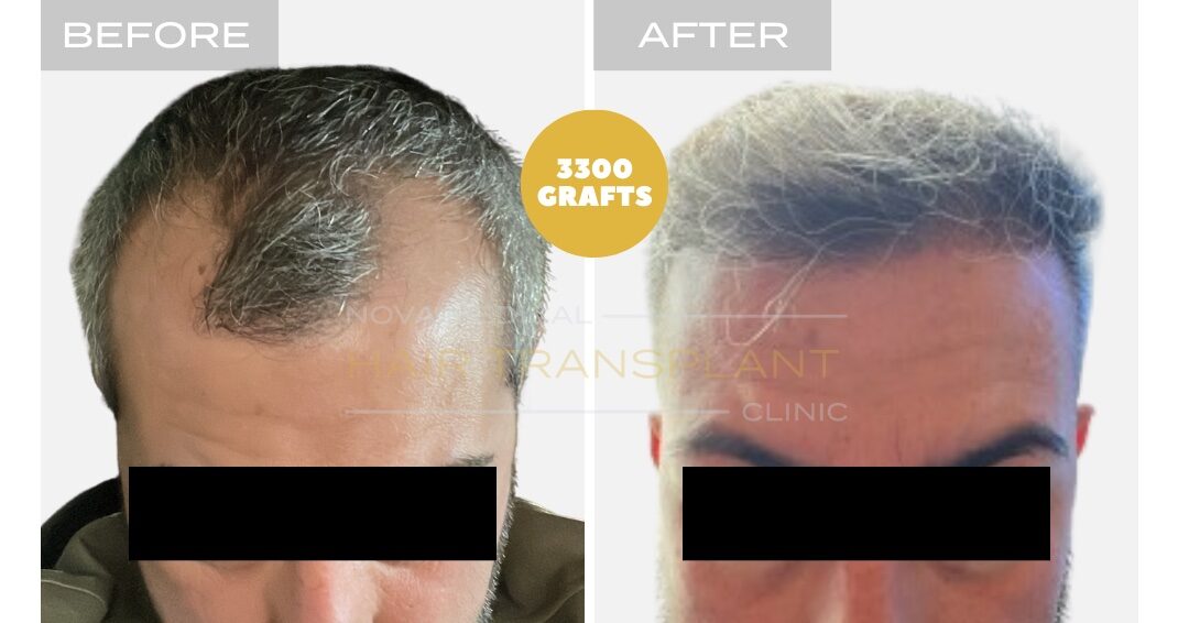 Hair Transplant Before & After Result 14 - HAIRLINE + FRONTAL DENSITY RESTORATION. MANUAL FUE 3000 GRAFTS., Nova Medical NYC