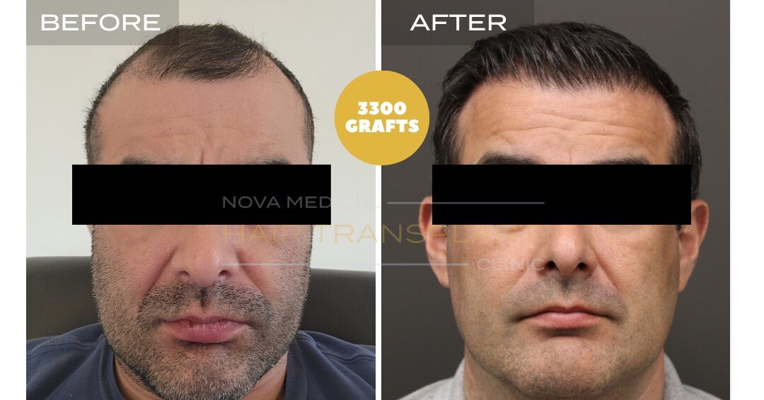 Hair Transplant Before & After Result 16 - HAIRLINE + FRONTAL DENSITY RESTORATION. MANUAL FUE + DHI 3300 GRAFTS., Nova Medical NYC