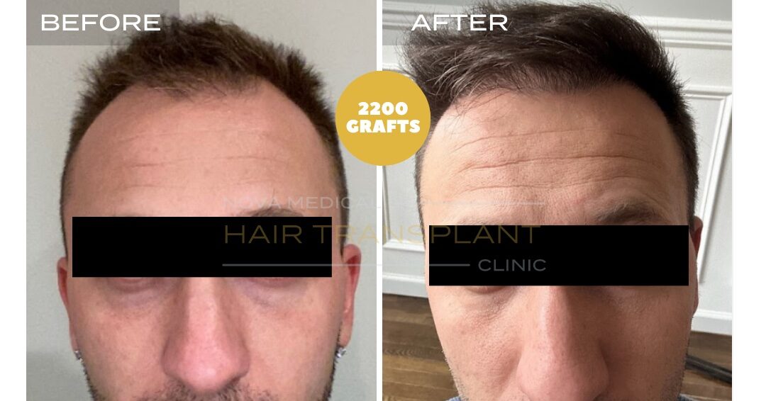 Hair Transplant Before & After Result 17 - HAIRLINE + CROWN DENSITY FILLING. MANUAL FUE 2200 GRAFTS., Nova Medical NYC