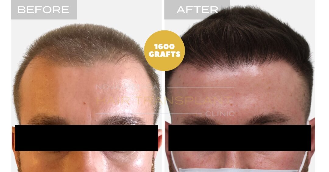 Hair Transplant Before & After Result 18 - HAIRLINE RESTORATION TOUCHUP. MANUAL FUE 1600 GRAFTS., Nova Medical NYC
