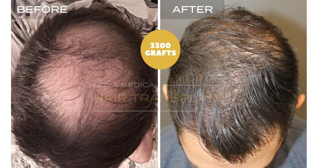 Hair Transplant Before & After Result 19 - CROWN + HAIRLINE RESTORATION. MANUAL FUE 3300 GRAFTS., Nova Medical NYC