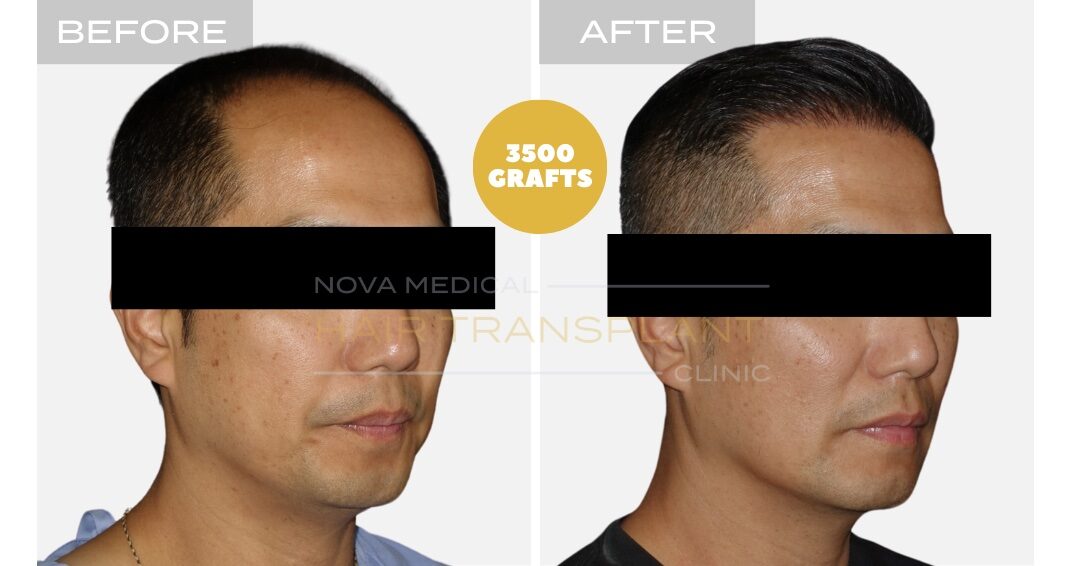 Hair Transplant Before & After Result 20 - HIGH DENSITY HAIRLINE RESTORATION. ASIAN HAIR MANUAL FUE 3500 GRAFTS., Nova Medical NYC