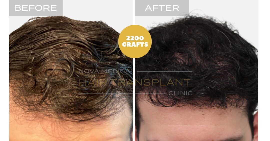 Hair Transplant Before & After Result 21 - HAIRLINE + DENSITY RESTORATION. MANUAL FUE 2200 GRAFTS., Nova Medical NYC