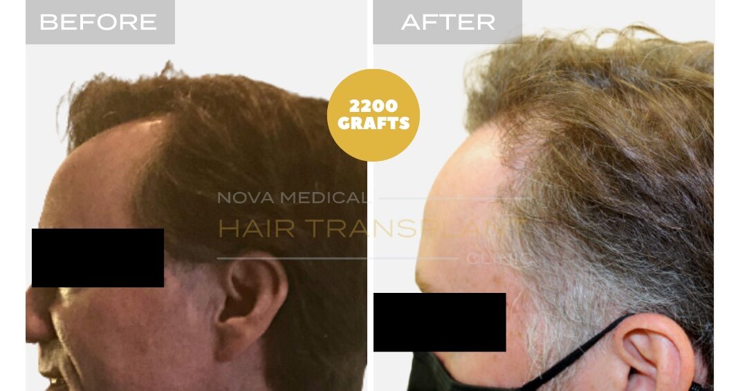 Hair Transplant Before & After Result 22 - TEMPLE FILLING + HAIRLINE RESTORATION. MANUAL FUE 2200 GRAFTS., Nova Medical NYC