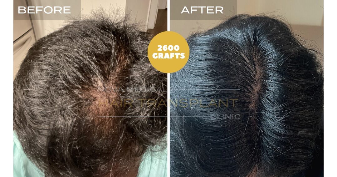 Hair Transplant Before & After Result 23 - CROWN DENSITY RESTORATION. MANUAL FUE 2600 GRAFTS., Nova Medical NYC