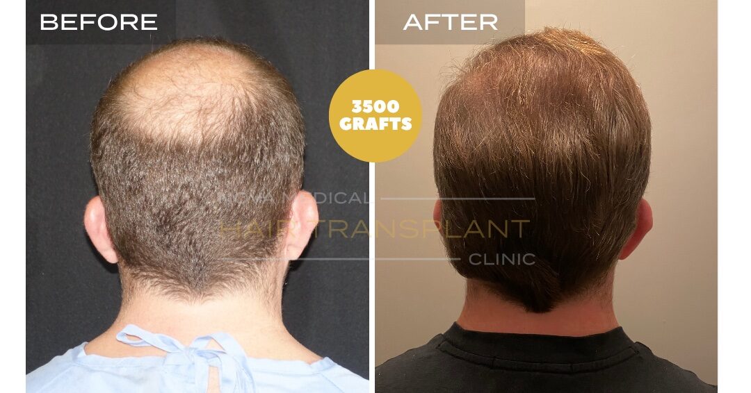 Hair Transplant Before & After Result 24 - CROWN DENSITY RESTORATION. MANUAL FUE 3500 GRAFTS., Nova Medical NYC