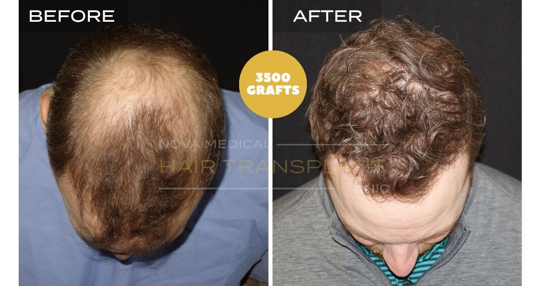 Hair Transplant Before & After Result 25 - CROWN + HAIRLINE RESTORATION. MANUAL FUE 3500 GRAFTS., Nova Medical NYC