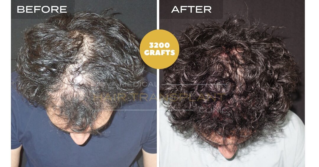 Hair Transplant Before & After Result 26 - DENSITY RESTORATION. MICRO FUE 3200 GRAFTS., Nova Medical NYC