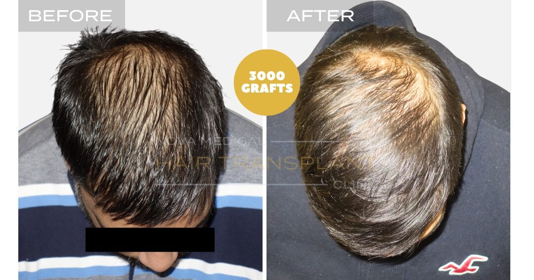 Hair Transplant Before & After Result 27 - HAIRLINE + DENSITY RESTORATION. MANUAL FUE 3000 GRAFTS., Nova Medical NYC
