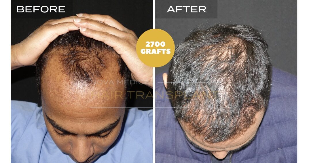 Hair Transplant Before & After Result 28 - HAIRLINE + DENSITY RESTORATION. MANUAL FUE 2700 GRAFTS., Nova Medical NYC