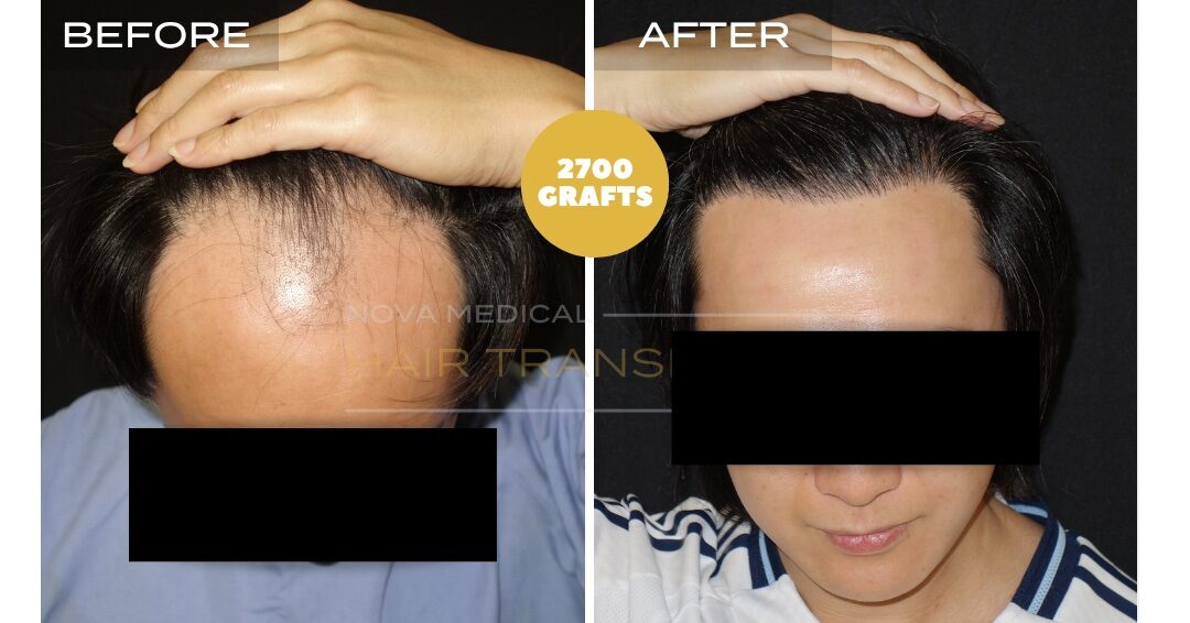 Hair Transplant Before & After Result 29 - HAIRLINE RESTORATION. MANUAL FUE 2700 GRAFTS., Nova Medical NYC
