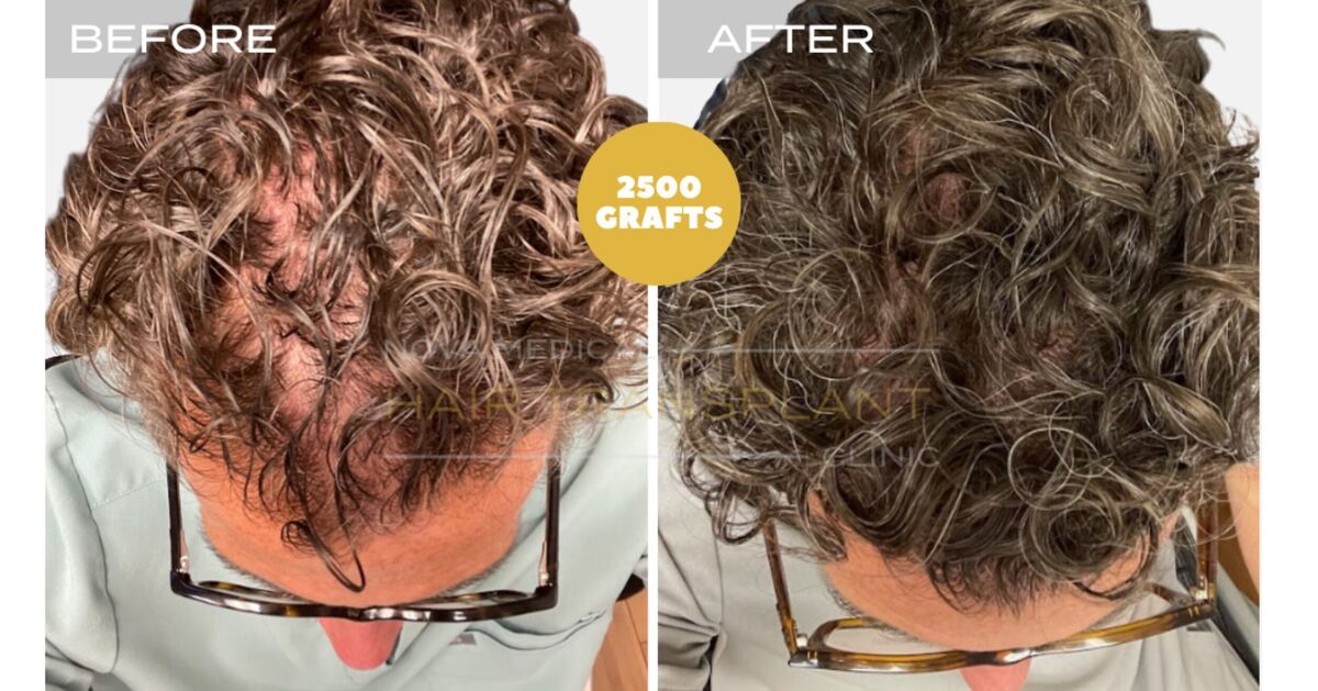Hair Transplant Video Case Study 1 - SHAVELESS MANUAL FUE 2500 GRAFTS FOR CURLY HAIR. DENSITY FILLING., Nova Medical NYC