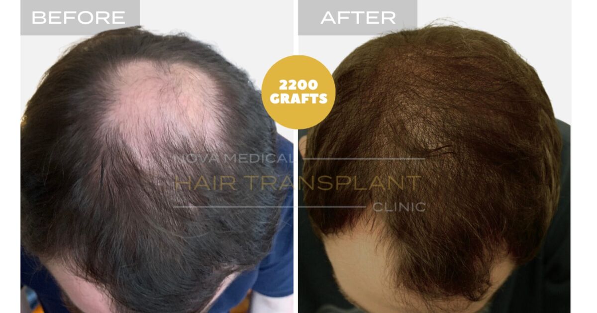 Hair Transplant Video Case Study 2 - CROWN FILLING. MANUAL FUE 2200 GRAFTS + DHI., Nova Medical NYC