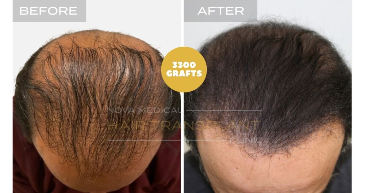 Hair Transplant Video Case Study 3 - LIMITED DONOR AREA. FIXING FACE TO FACE APPEARANCE + DENSITY FILLING, Nova Medical NYC