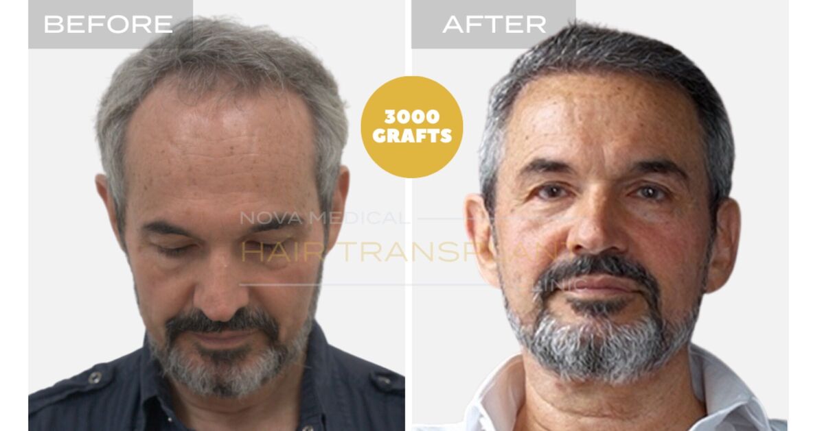 Hair Transplant Video Case Study 4 - HAIRLINE RESTORATION + DENSITY FILLING. MANUAL FUE 3000 GRAFTS., Nova Medical NYC