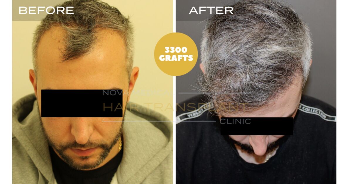 Hair Transplant Video Case Study 5 - HAIRLINE RESTORATION DENSITY FILLING. MANUAL FUE 3300 GRAFTS., Nova Medical NYC