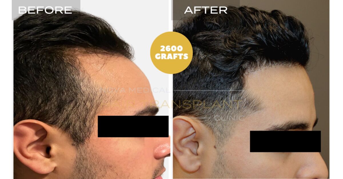 Hair Transplant Video Case Study 6 - TEMPLE FILLING + HAIRLINE RESTORATION. MANUAL FUE 2600 GRAFTS., Nova Medical NYC