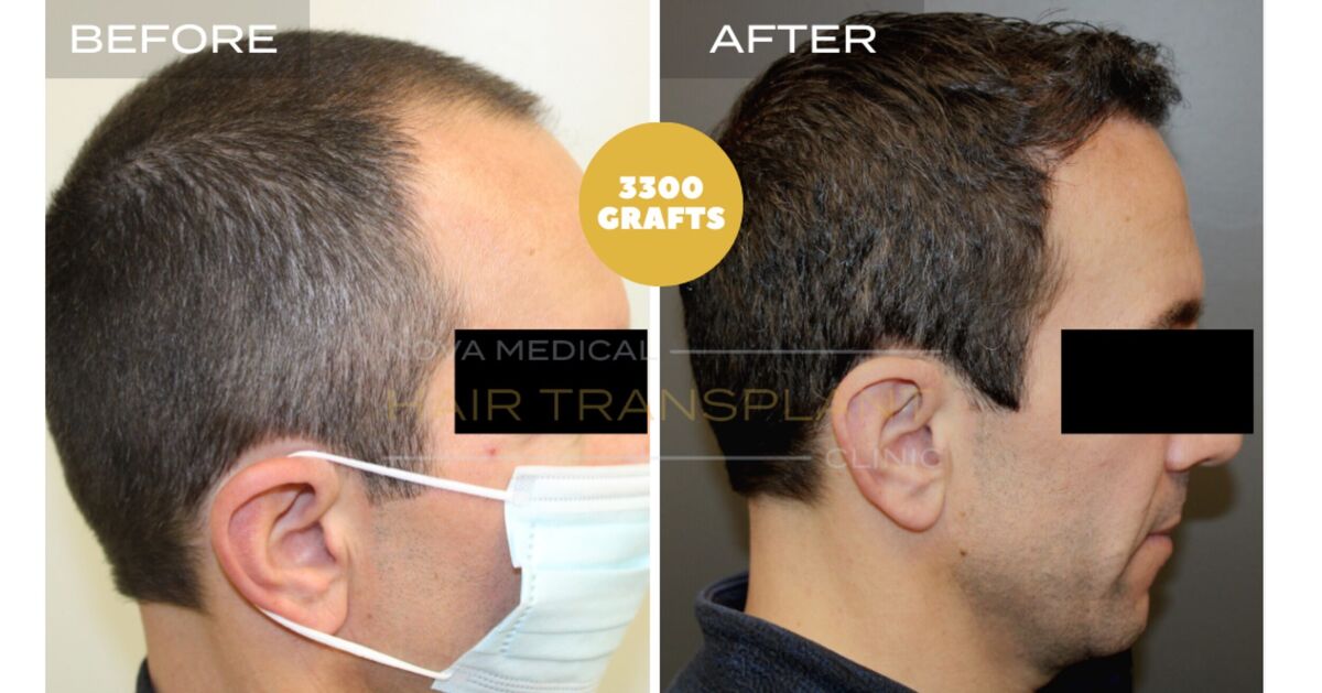 Hair Transplant Video Case Study 7 - TEMPLE FILLING + HAIRLINE RESTORATION. MANUAL FUE 3300 GRAFTS., Nova Medical NYC