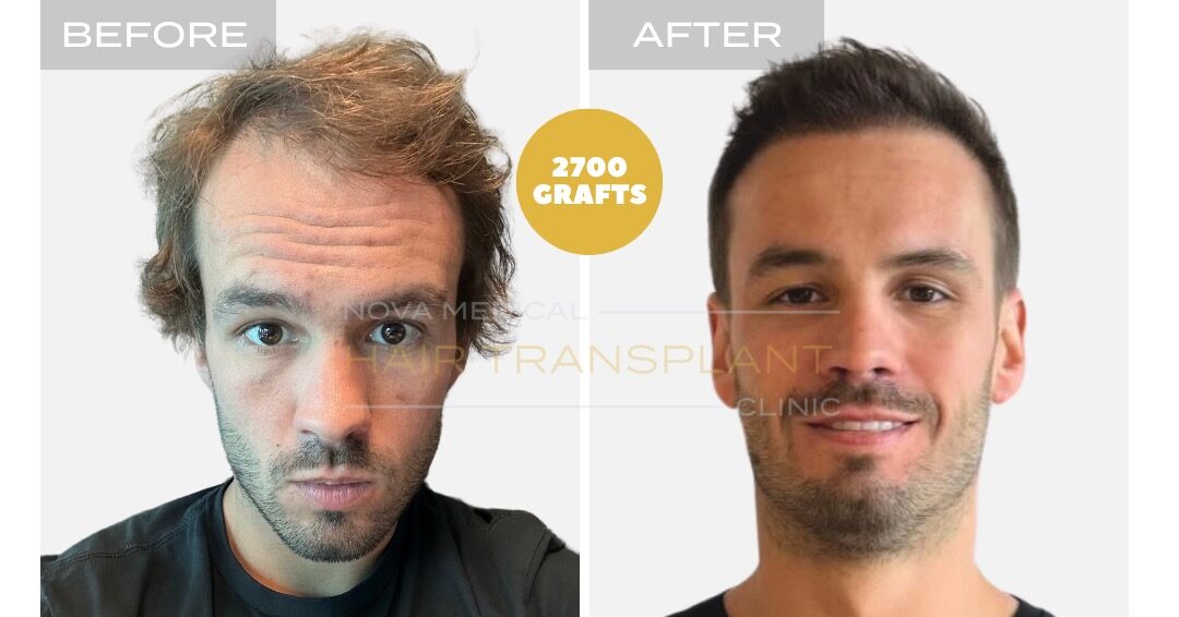 Hair Transplant Before and After - Patient 1, Nova Medical NYC