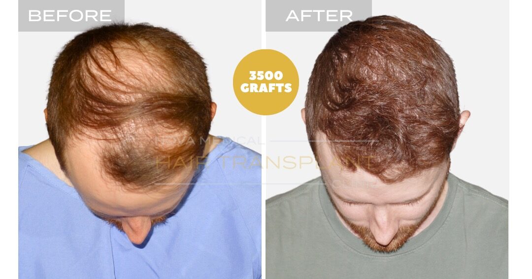 Hair Transplant Before and After - Patient 2, Nova Medical NYC