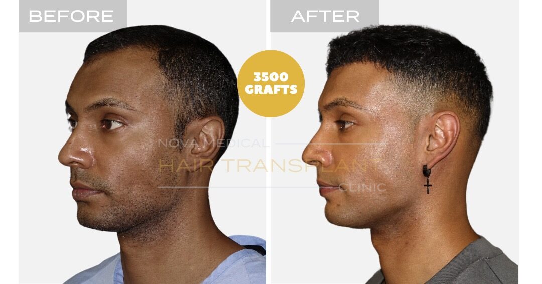Hair Transplant Before and After - Patient 3, Nova Medical NYC