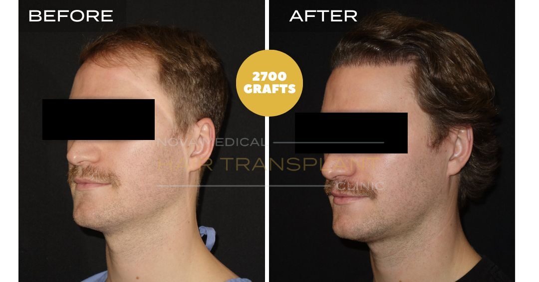 Hair Transplant Before and After - Patient 5 angle 2, Nova Medical NYC